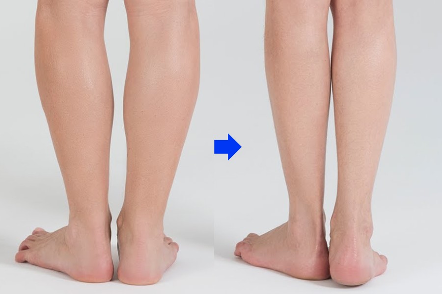 Đánh giá và theo dõi tiến trình giảm bắp chân